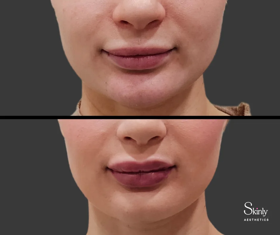 Before and after Russian lip technique, showing increased lip plumpness.