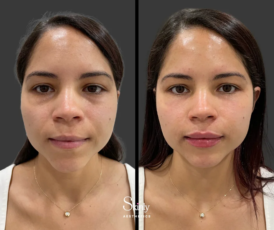 Before and after smile line filler, showing a refreshed appearance.
