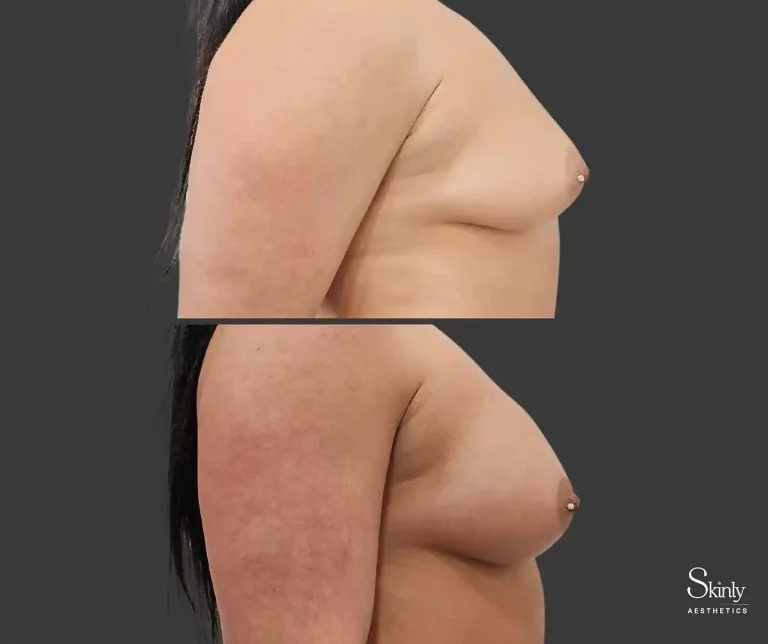 Side view before and after liquid breast lift showing increased volume