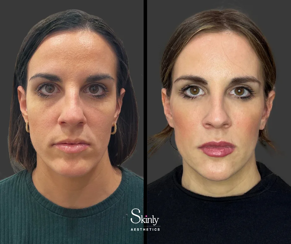 Before and after midface filler, restoring volume in the midface.