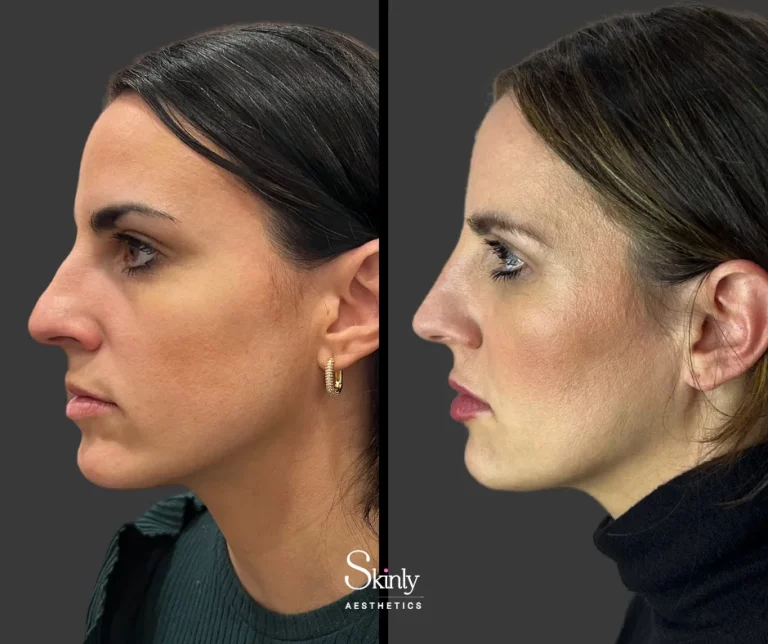 Before and after liquid nose job, showing elevated nose tip.