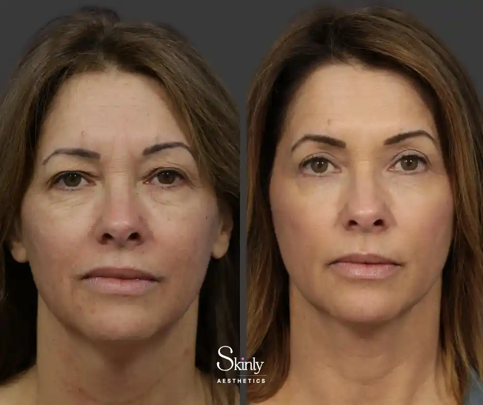 Wrinkle reduction CO2 laser NYC before after