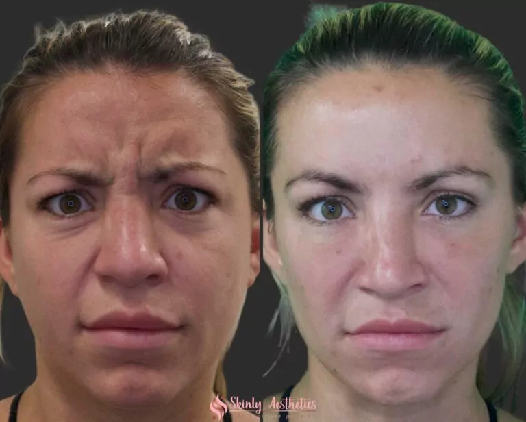 botox 11s lines 2