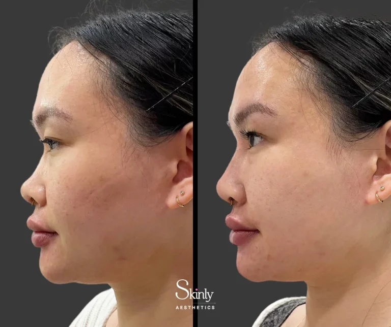 Before and after nose tip filler, showing improved tip projection.