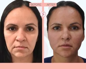 PDO ThreadLift