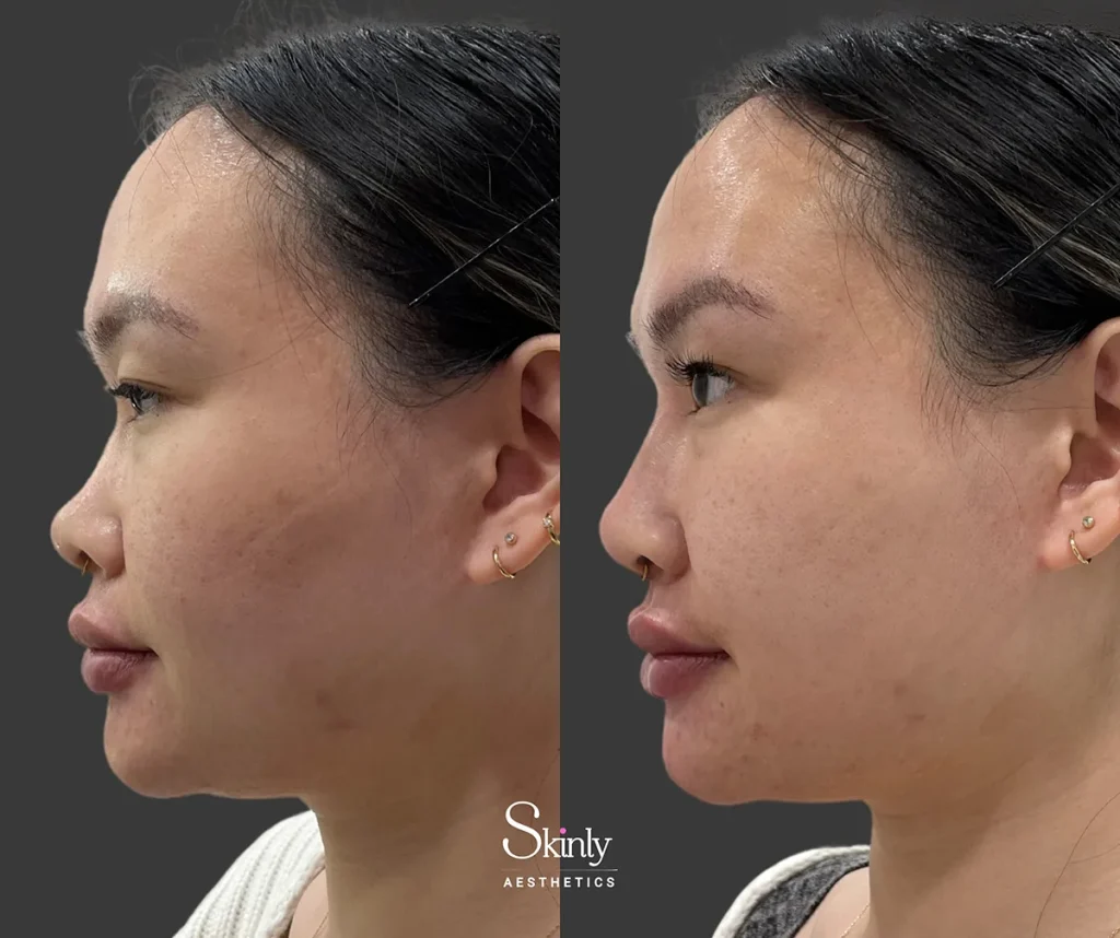 Non-surgical nose job before and after with lifted nasal bridge