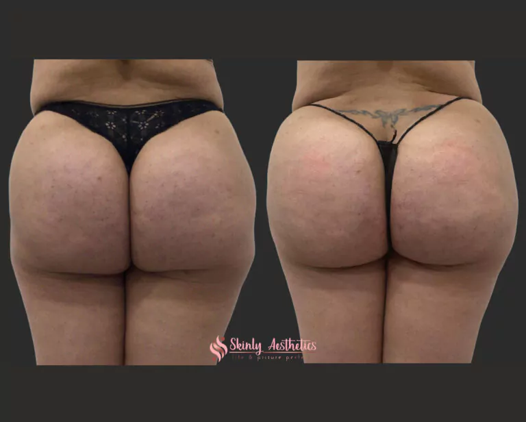 sculptra filler buttocks injections