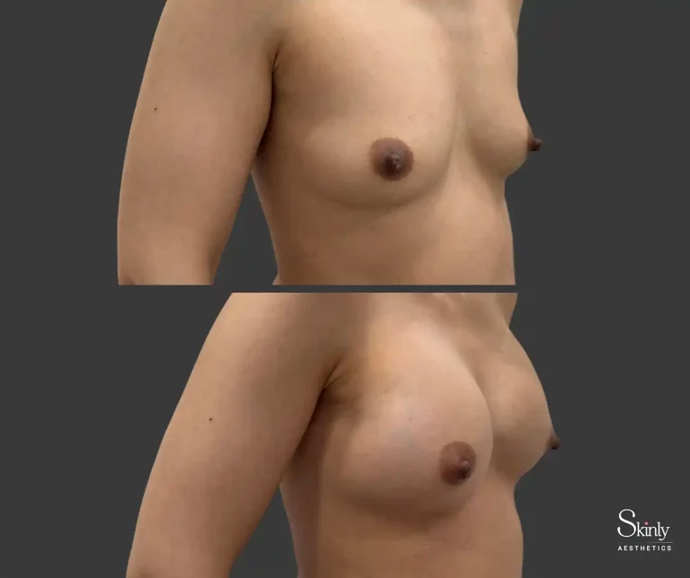 Side before-and-after results of liquid breast lift