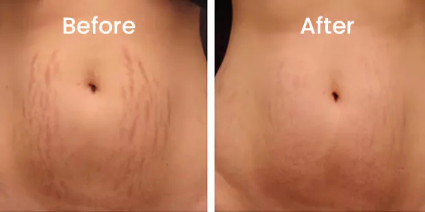 before and after results of treating stretch marks with microneedling before and after results of treating stretch marks with microneedling