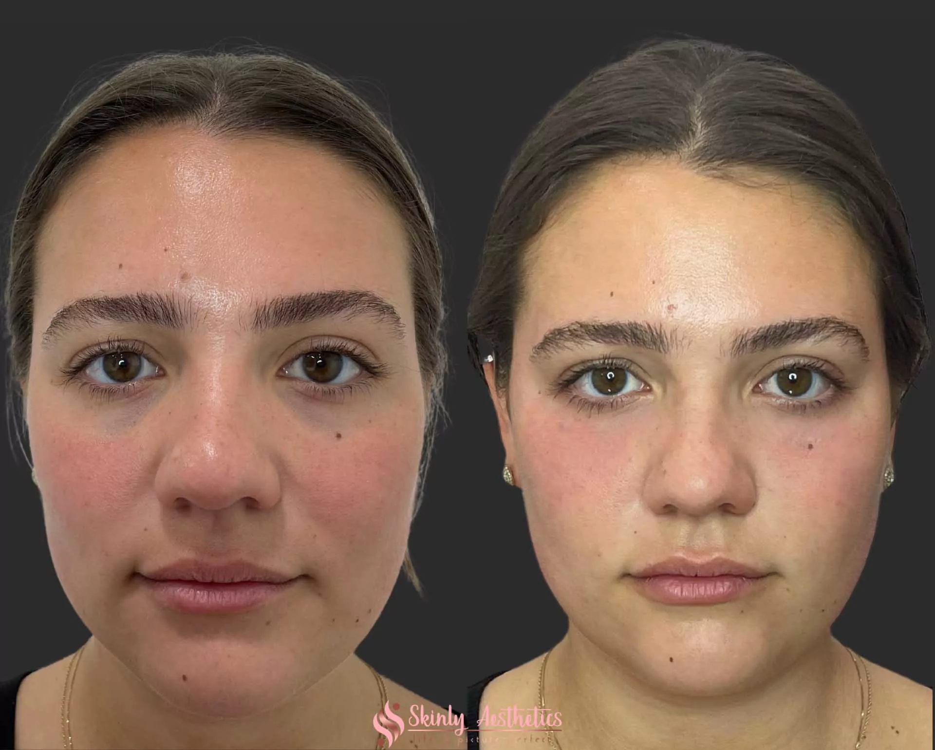 under eye dark circle treatment with Restylane dermal filler