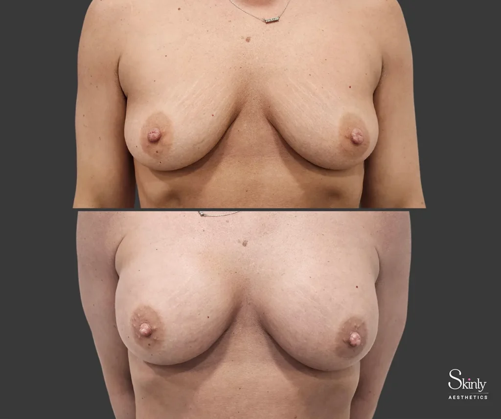 Breast lift results front view showing increase cup size and shape