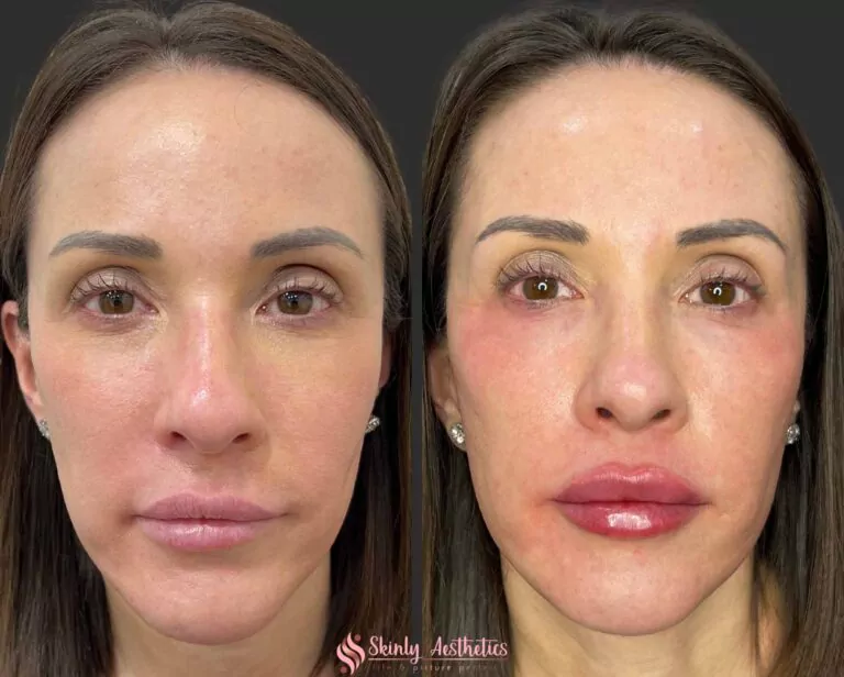 Russian lip filler technique treatment with Juvederm