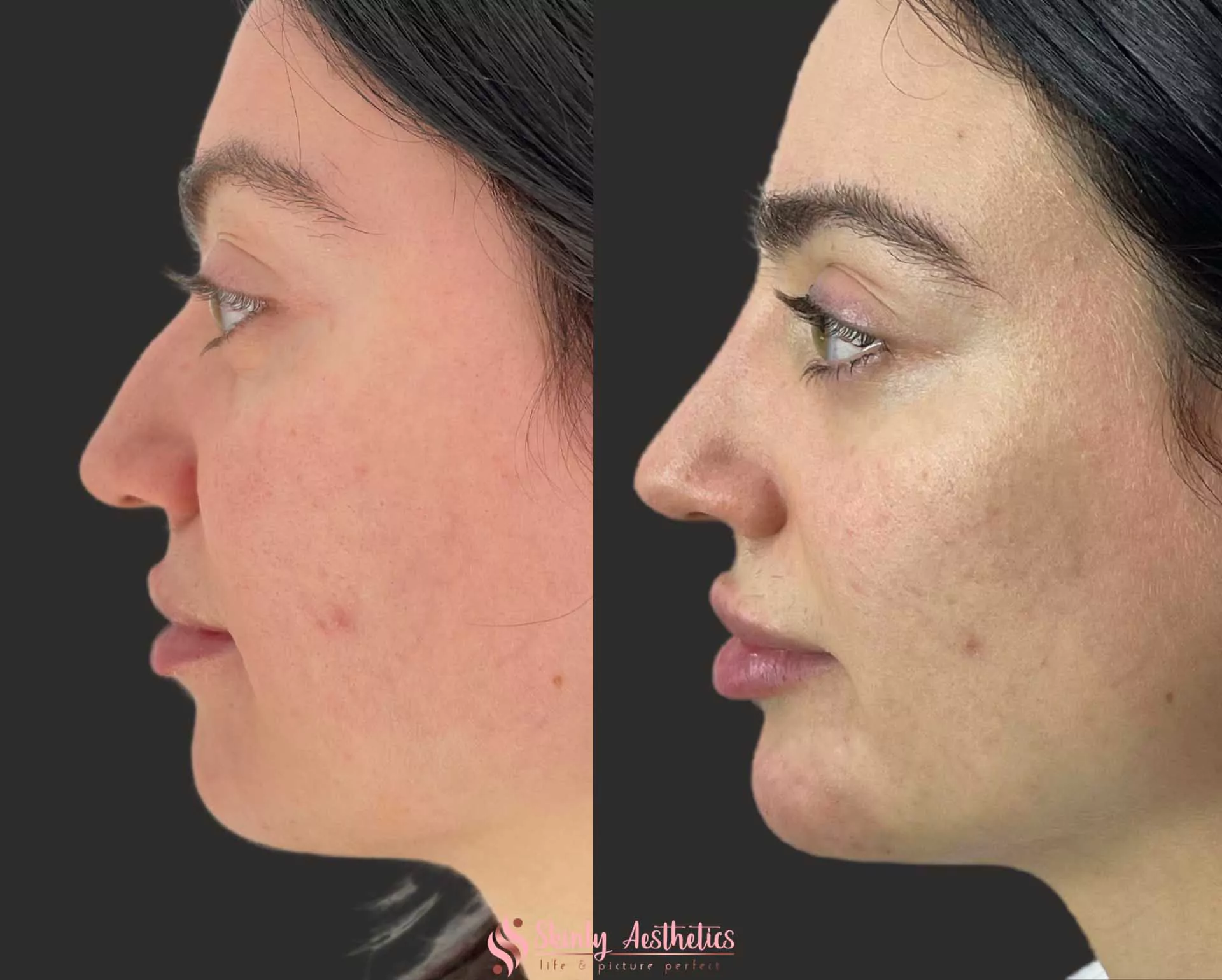 liquid rhinoplasty with Restylane filler