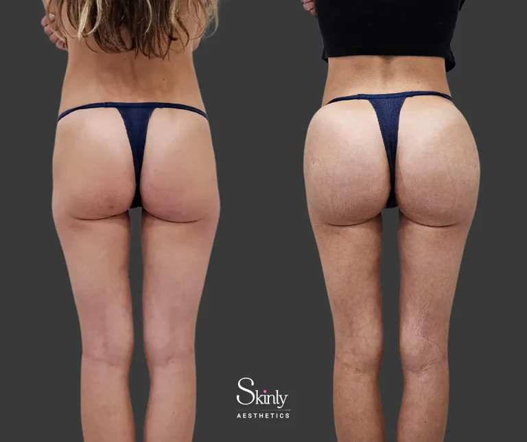 Hyaluronic acid and PLLA filler results from rear side view