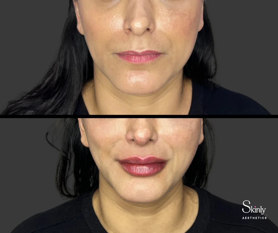 Before and after lip augmentation showing fuller lips.