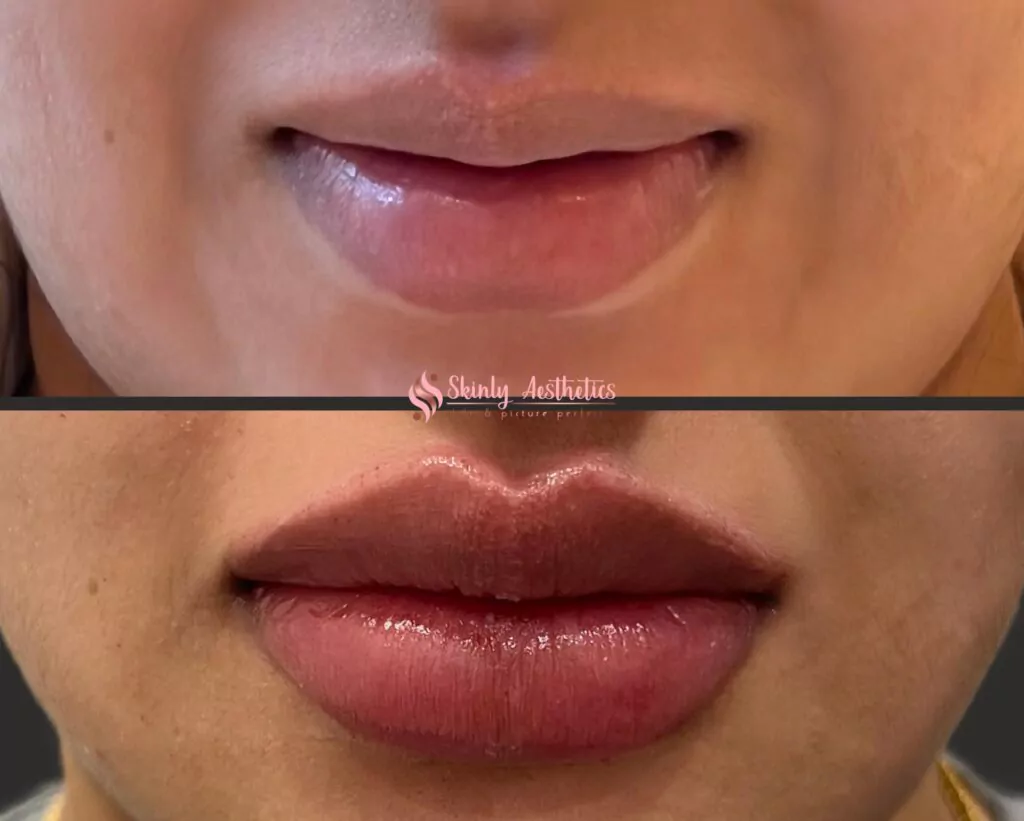 Russian lip filler augmentation technique with Juvederm filler