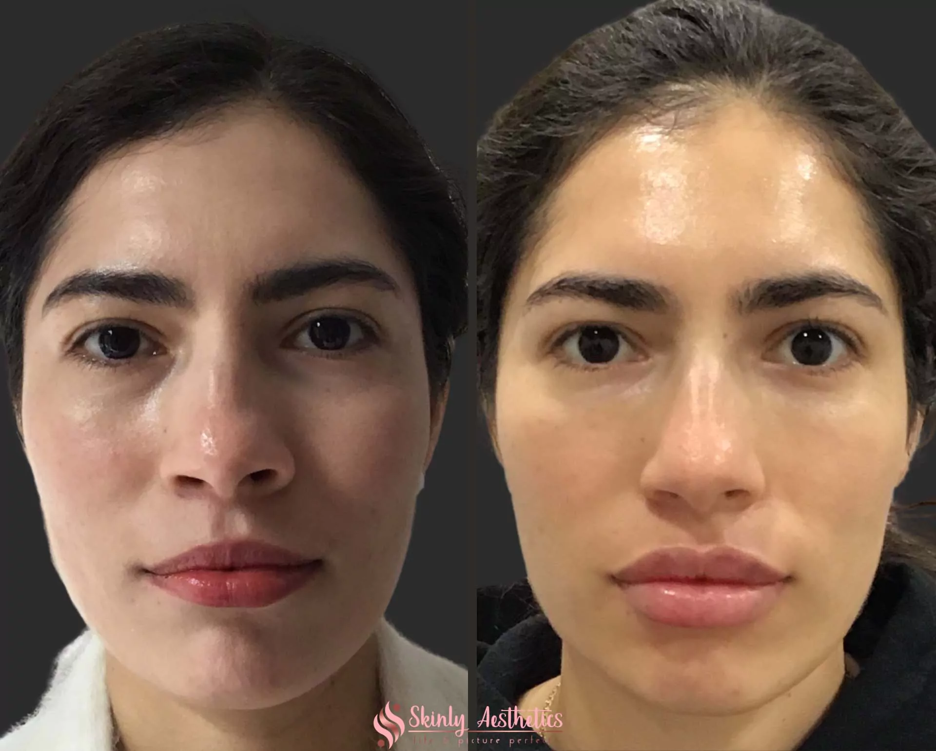 Russian lip filler augmentation technique