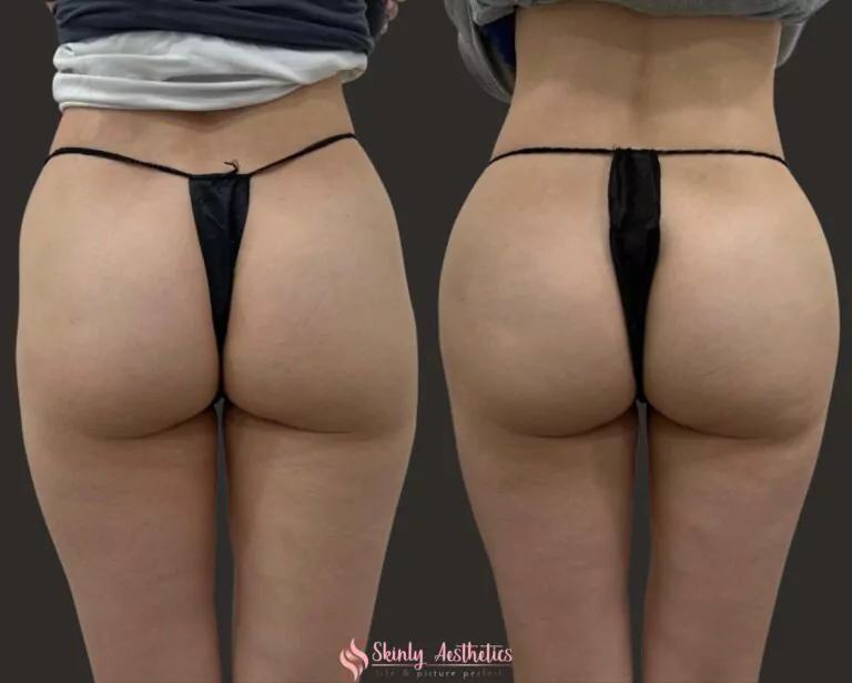 Sculptra bubble butt injections