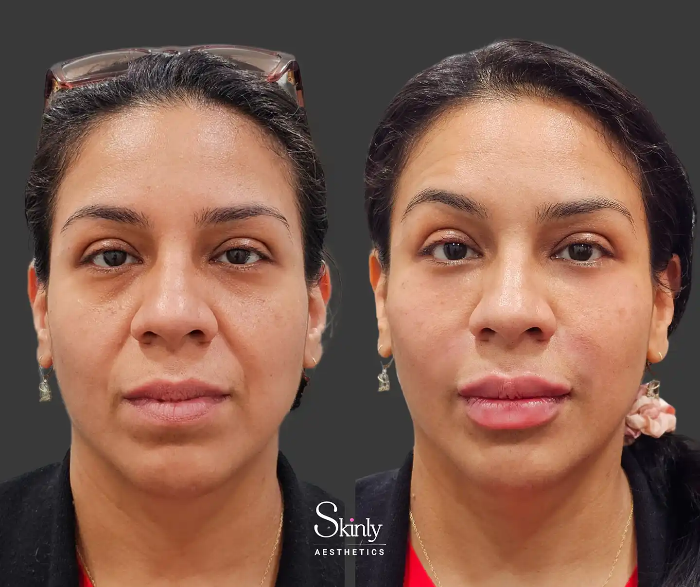 Front view highlighting smoother skin texture and diminished under-eye hollowness post-liquid facelift