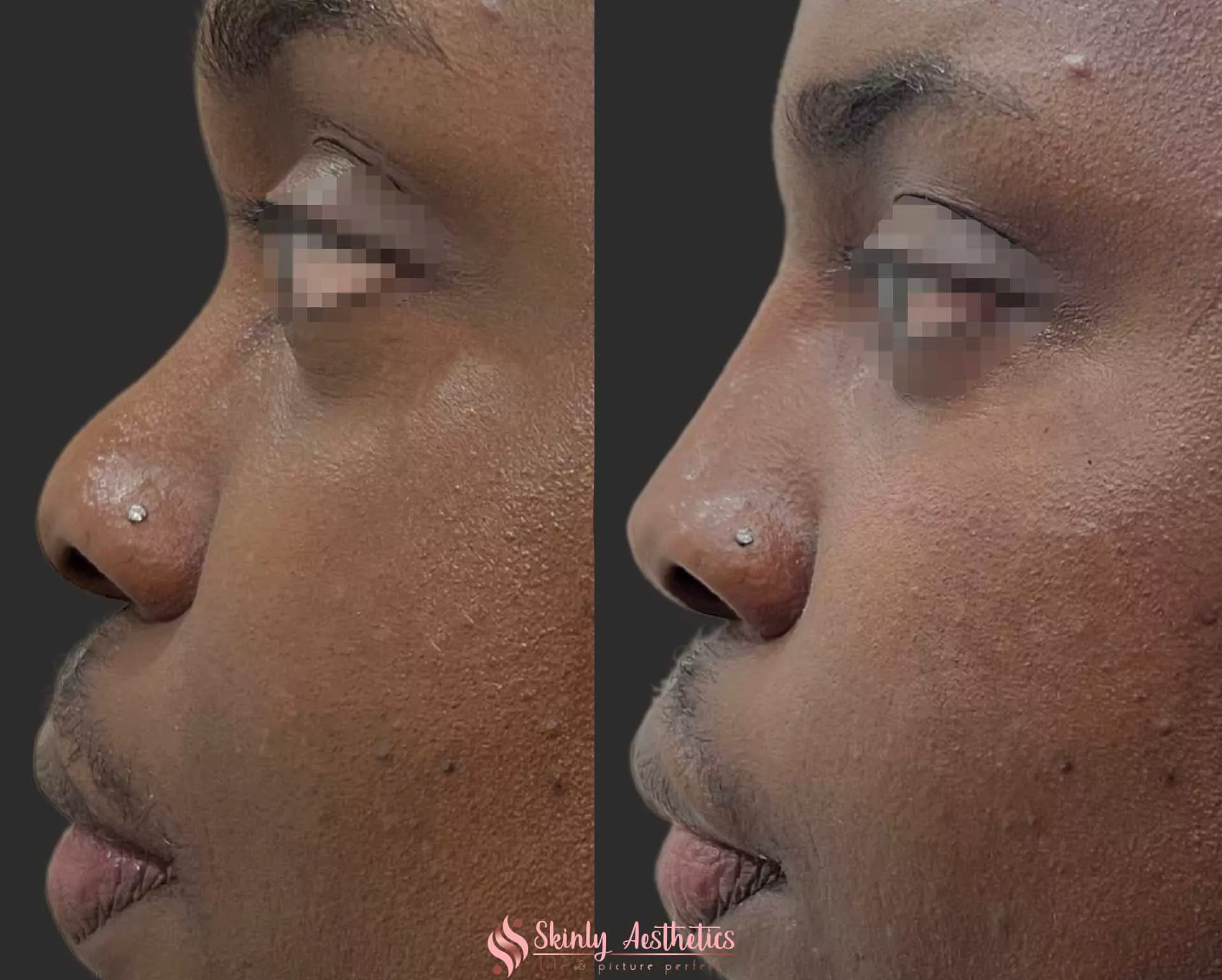 non surgical liquid rhinoplasty for nose bridge and tip augmentation