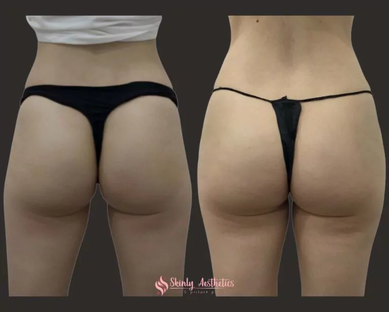 Sculptra filler hips results