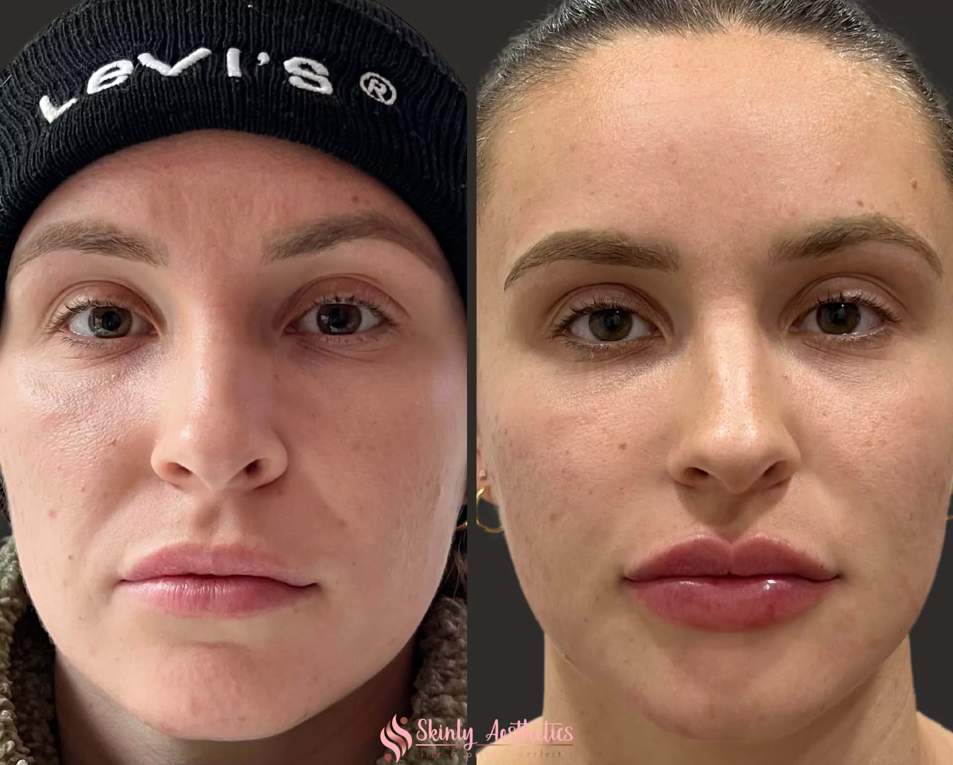 lip augmentation juvederm ultra