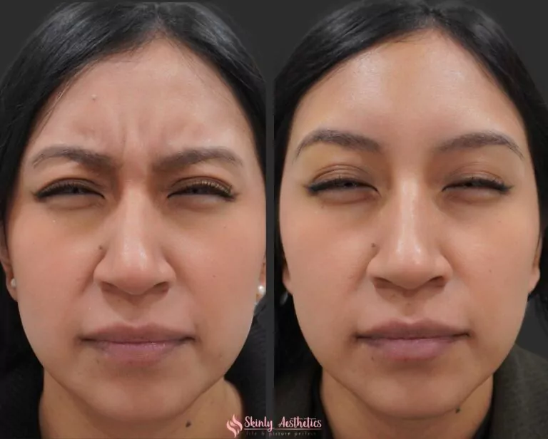 resolution of 11s line following administration of 20 units of Botox