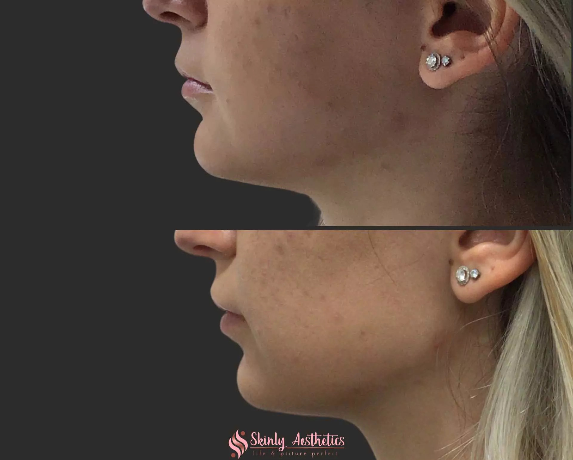 dermal filler jawline shaping