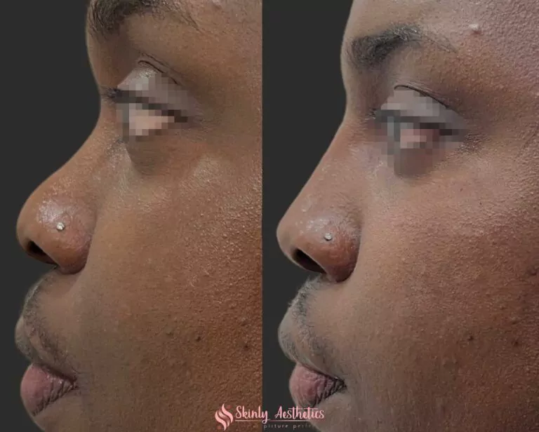 non surgical liquid rhinoplasty for nose bridge and tip augmentation