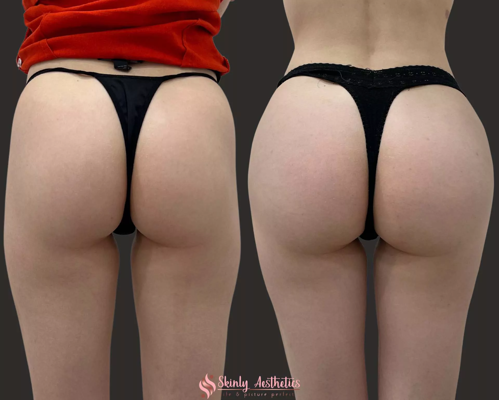 Sculptra filler injections for deep hip dips dents