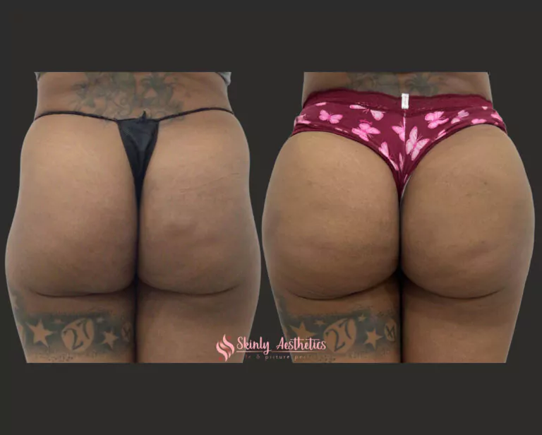 sculptra butt injections 2