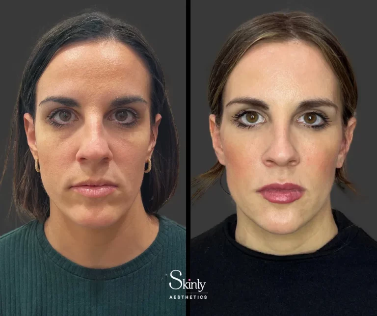 Before and after liquid facelift, showing restored facial volume.