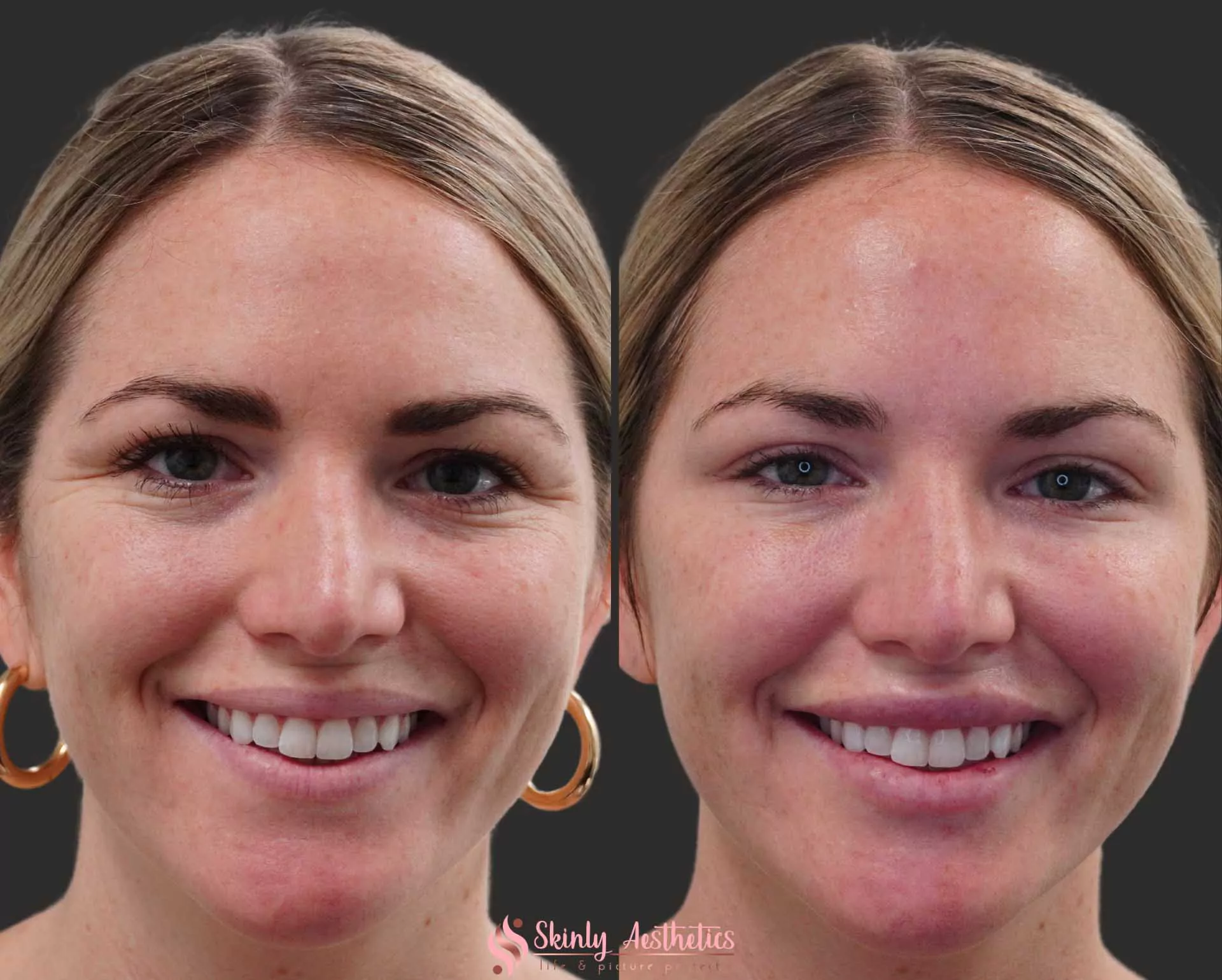 botox treatment crows feet