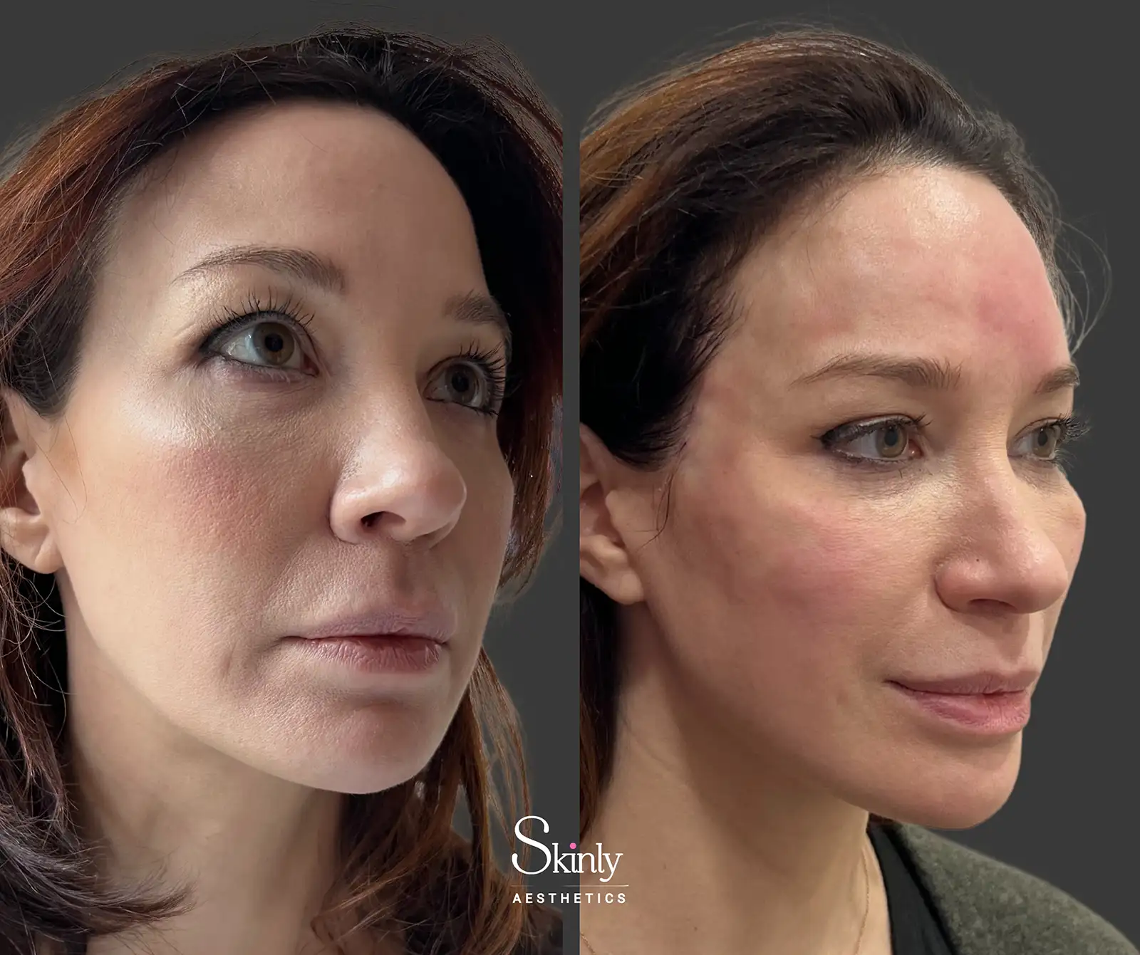 Forehead filler before and after showing improved curvature and smoother upper face contour
