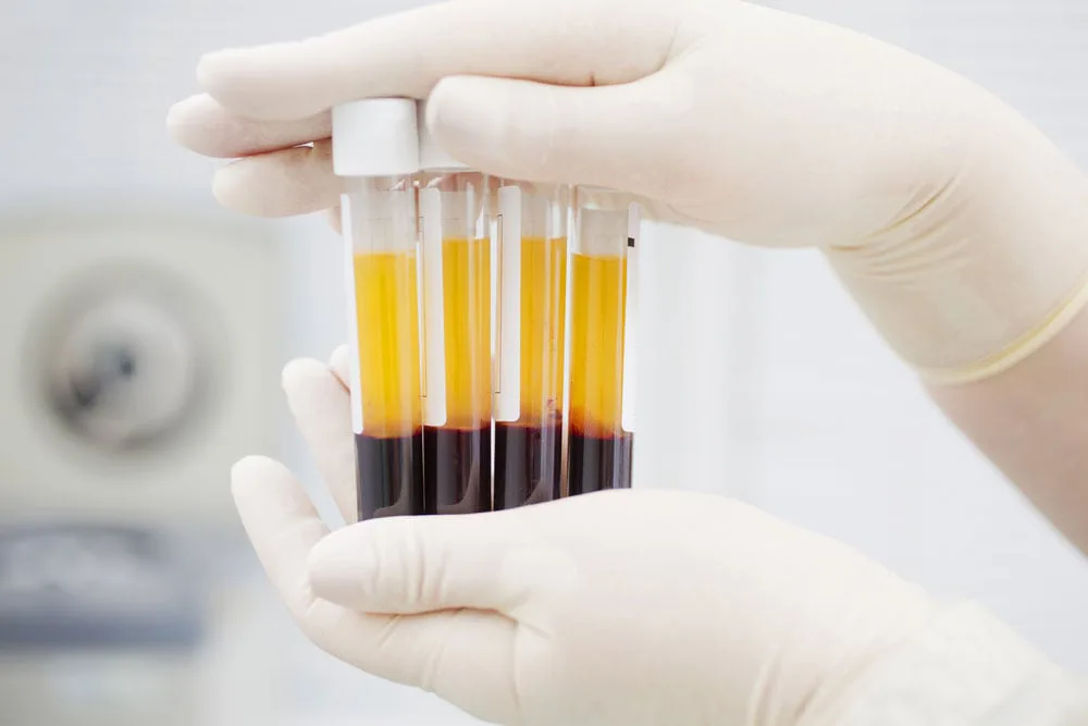 PRP blood processing tubes prepared for breast enhancement treatment