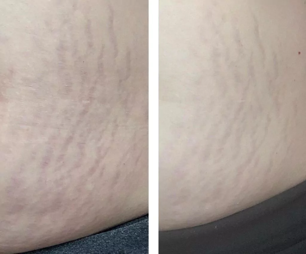 before and after results of stretch marks treated with topical retinol before and after results of stretch marks treated with topical retinol