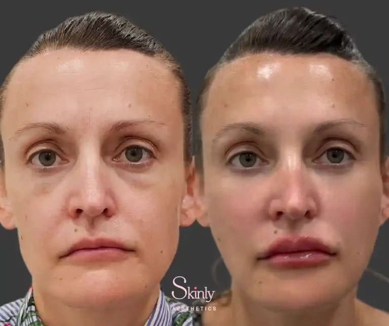 Liquid Facelift results showing instantly lifted cheeks, reduced smile lines and smooth under eyes
