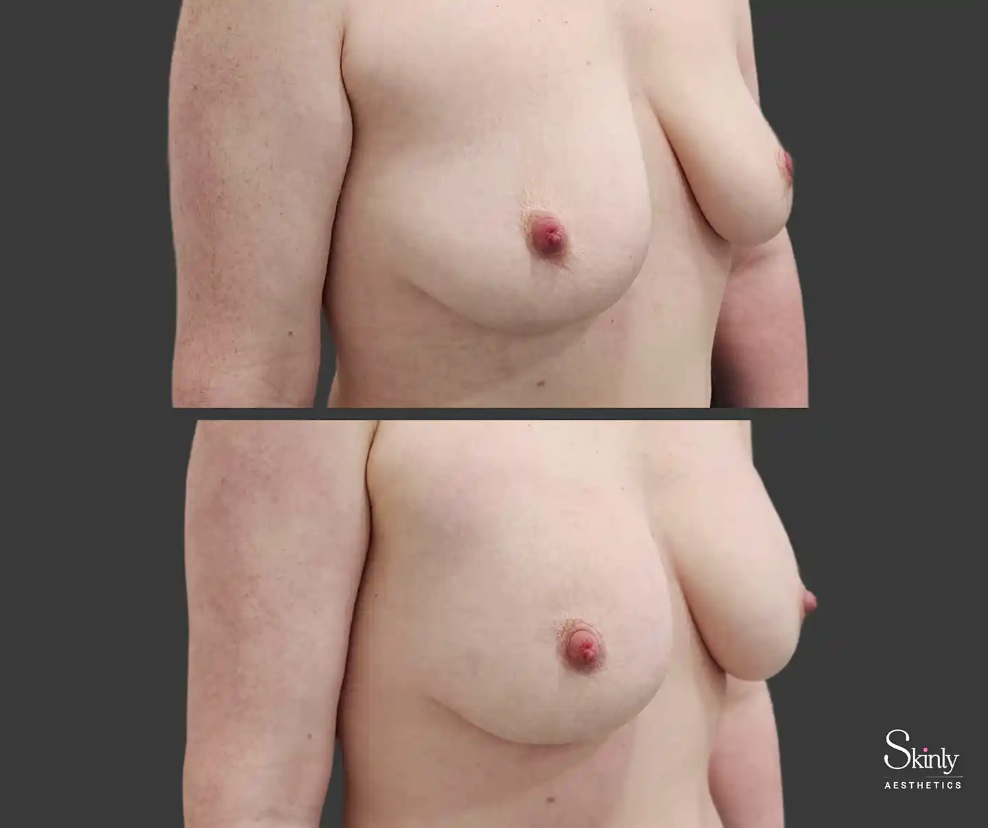 Side-view breast enhancement showing improved volume