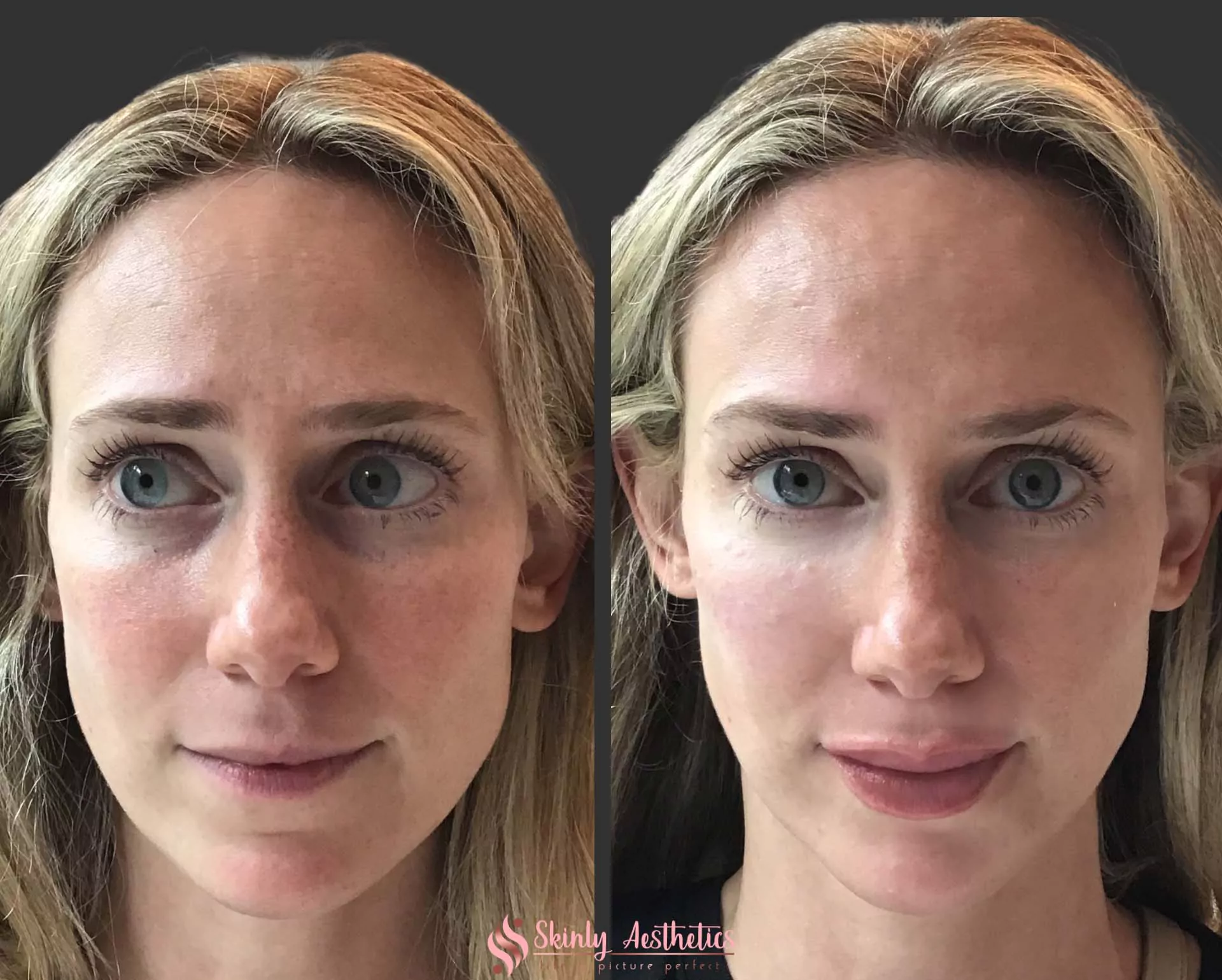 juvederm dermal filler lip injection