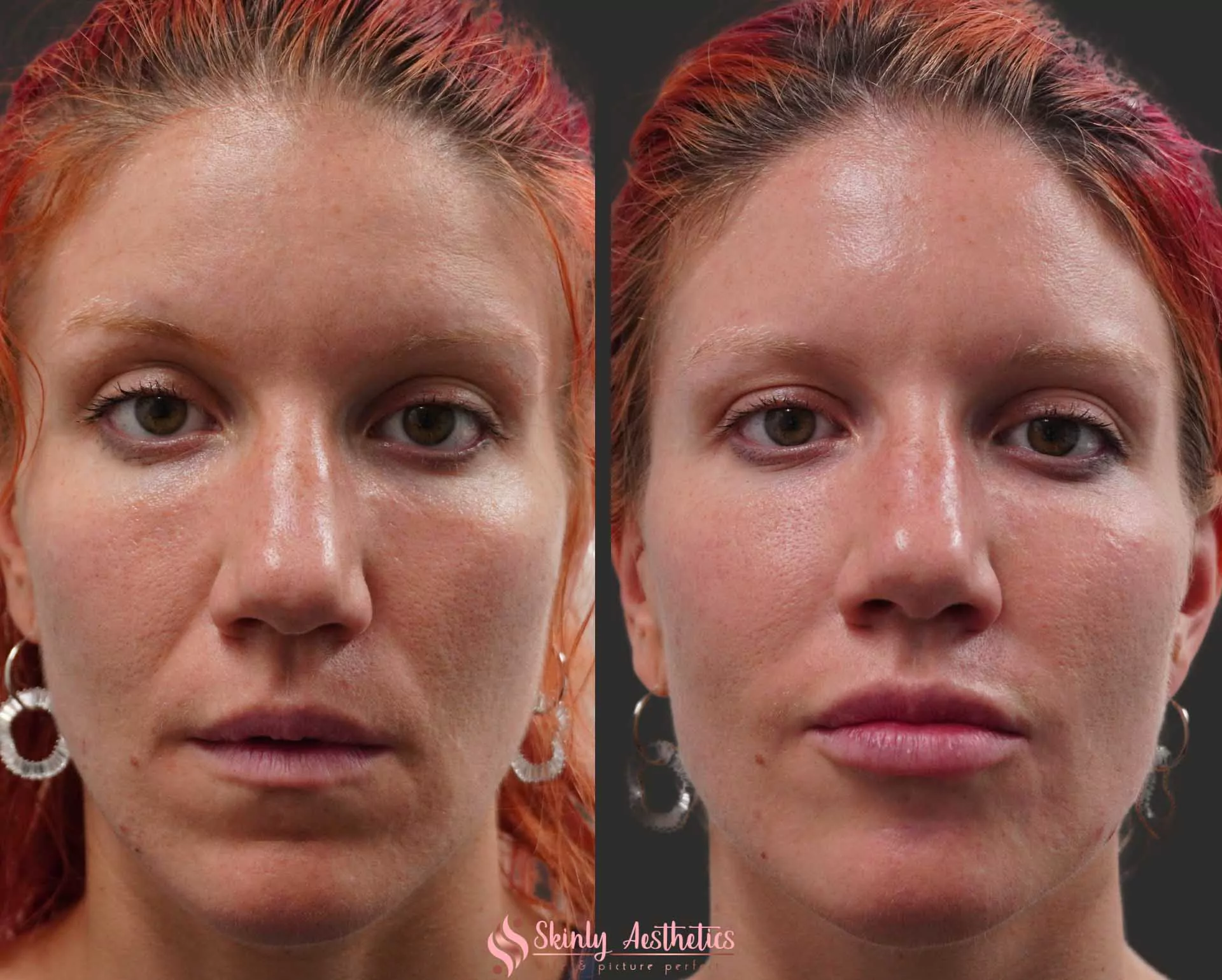 nasolabial fold smoothing Restylane filler