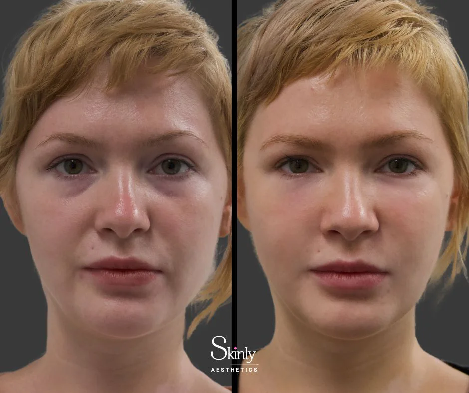 Before and after tear trough filler showing corrected under eye hollows.