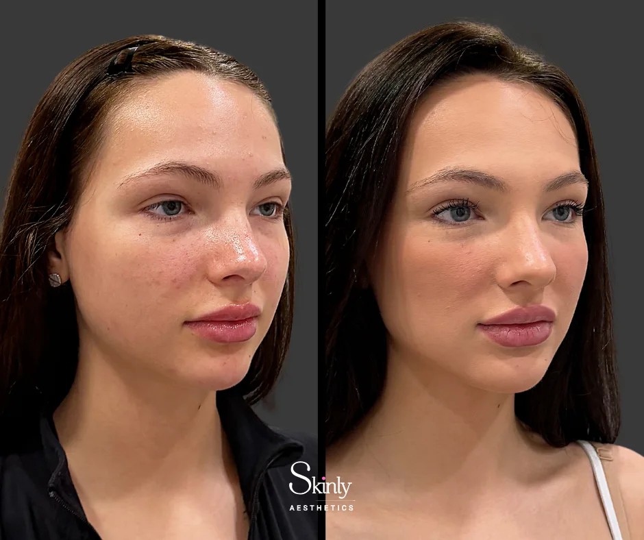 Before and after results masseter Botox to soften jawline.