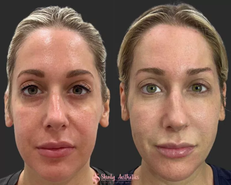 PDO thread lift with barbed sutures to lift droopy cheeks and jowls