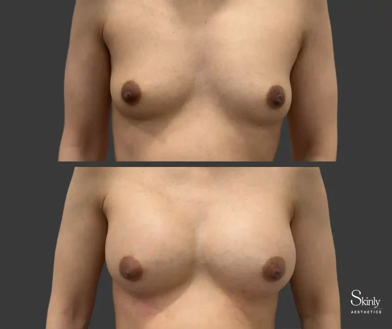 Front view NYC patient breast lift with fillers
