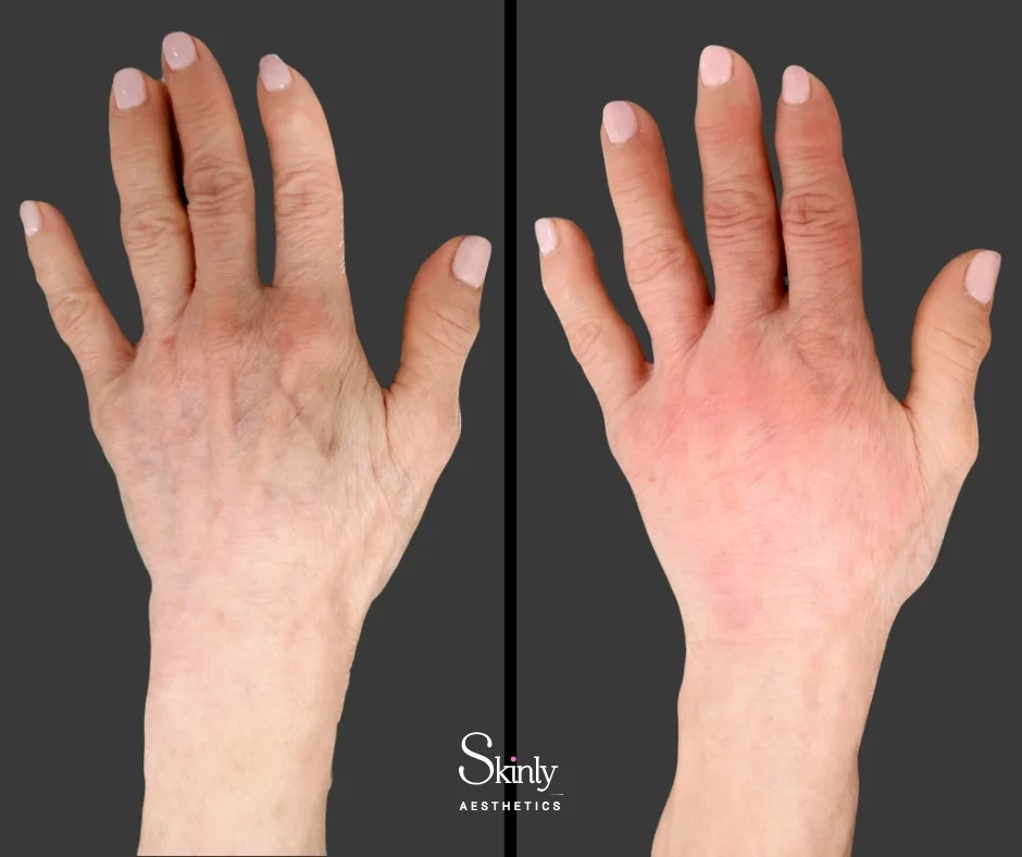Hand filler before and after plumping results