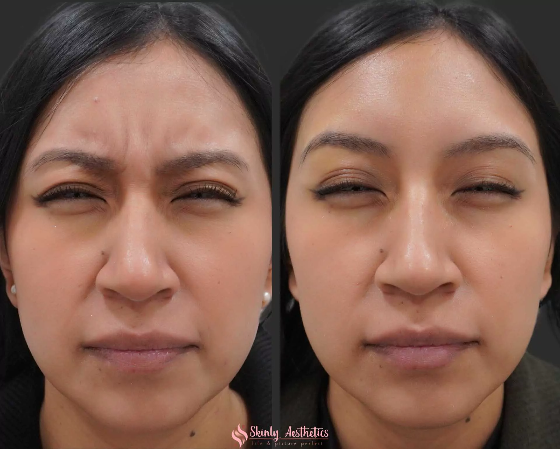 resolution of 11s line following administration of 20 units of Botox
