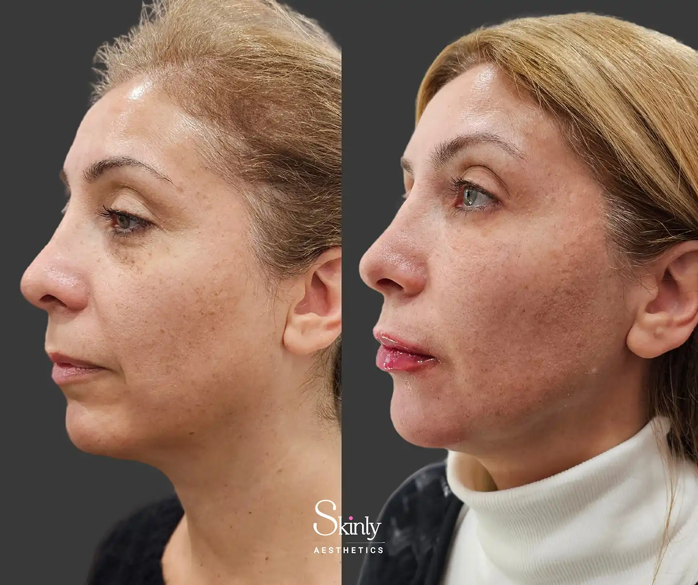 Side image showing significant reduction in skin laxity and improved jawline after liquid facelift